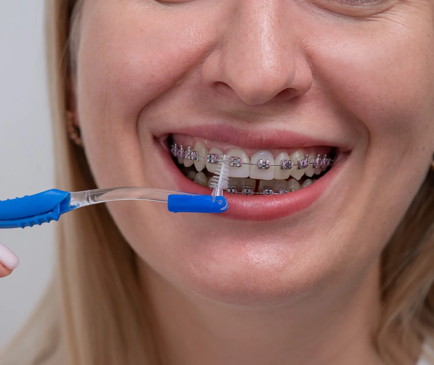 Imagem de destaque de Como escovar os dentes usando aparelho fixo?