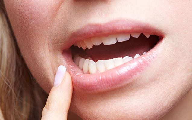 Aftas: quais as suas causas e como combatê-las - Instituto Sonia Canto Odontologia • Clinica Odontológica na Tijuca