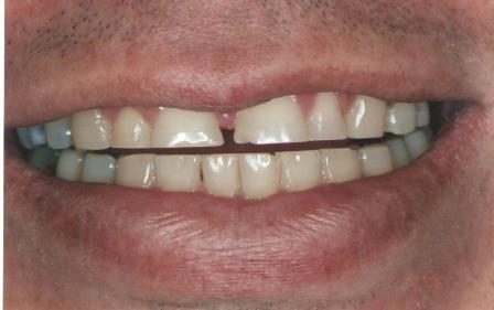 Sorriso Inicial - Dentes Desgastados