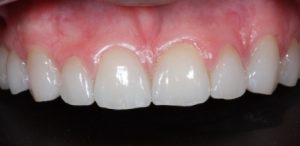 Close Dentes Faceta Cerâmica