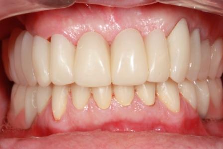 Visão Oclusal e Guias dos Dentes após cimentação